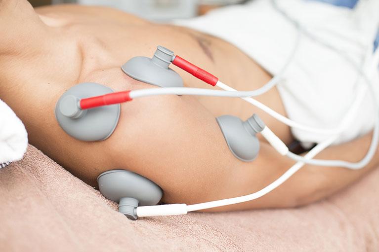 Electro stimulation leads attached to a patient's shoulder