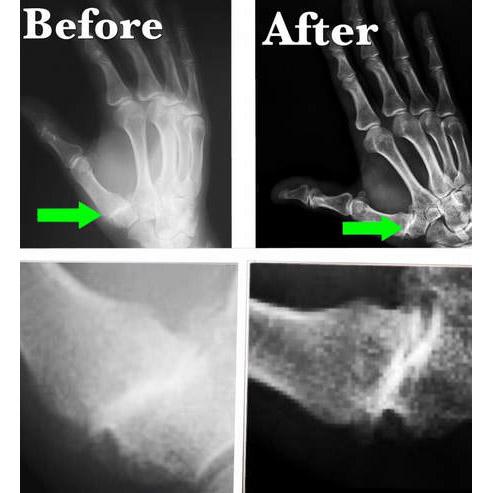 X-Ray scan of a hand before (left) and after (right) SoftWave Therapy